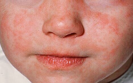 240124sarampion2 edited